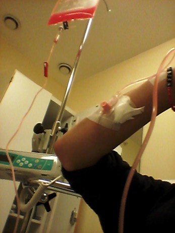 2017-08-08 Kanyl i armen 2