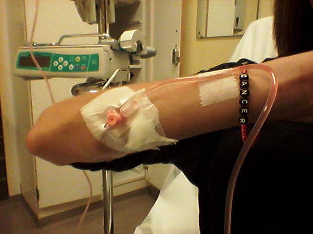 2017-08-08 Kanyl i armen 1