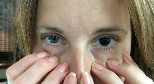 2017_07_26 Så här ser man ut efter att ha fått pupill- vidgande ögondroppar!